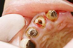 歯を残す治療「エクストリュージョン法」